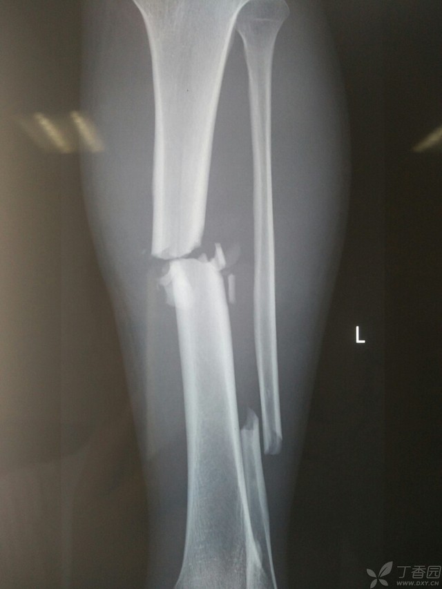 科技重塑脛腓骨骨折康復之旅，引領未來體驗新篇章