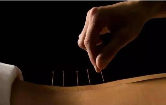 平衡針灸最新視頻，現(xiàn)代應(yīng)用探索針灸藝術(shù)的新境界