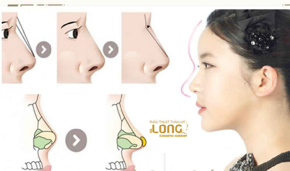 最新鼻整形技術(shù)重塑自信，煥發(fā)新生之美